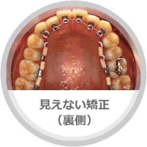 見えない矯正
